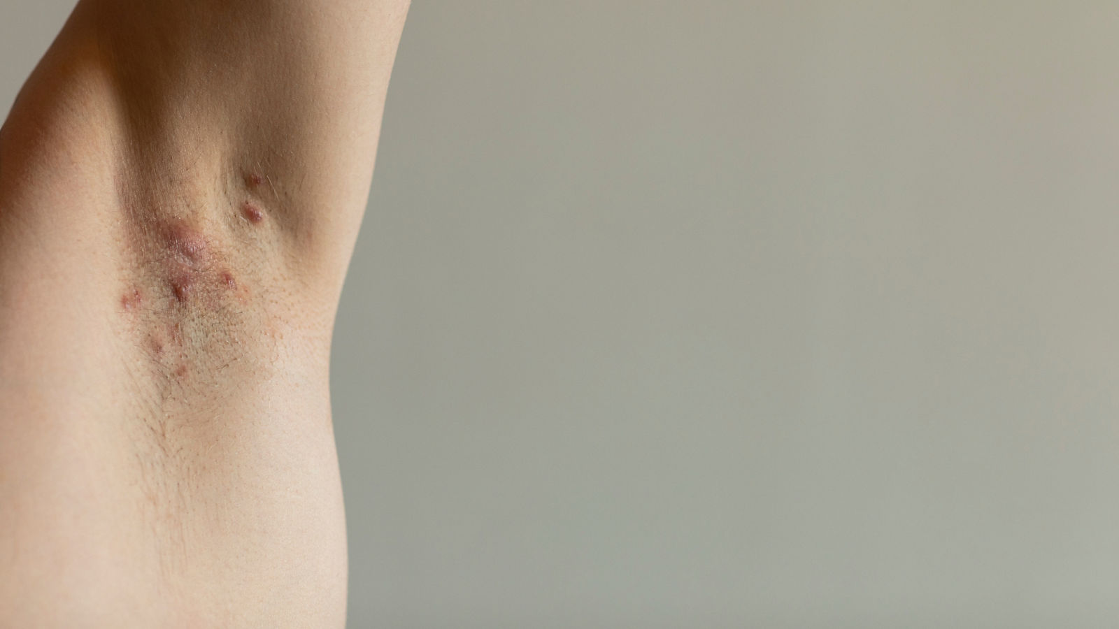 A patient diagnosed with Crohn’s disease with hidradenitis suppurativa under his armit with visible red painful fistulas. Irritated skin and hair follicles, abcess. Close up