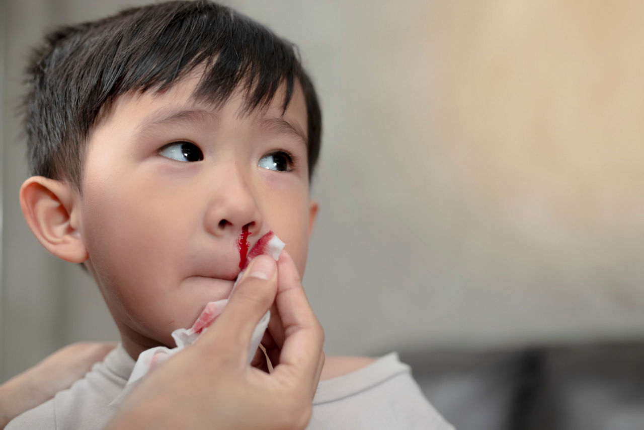 kann man vom vapen nasenbluten bekommen ❓ Habt ihr auch ab und zu Nasenbluten? . 👃Nasepopeln kann Nasenbluten  auslösen. Aber nicht nur das – auch durch zu festes Putzen können die  feinen Blutgefäße im vorderen Teil der Nase main image 1