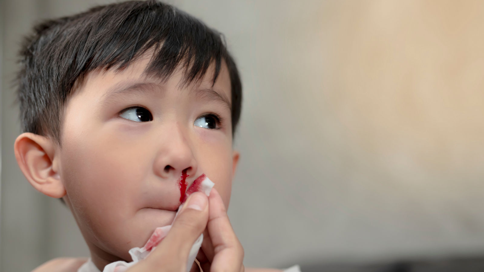 Portrait of cute Asian ethnic child having nosebleed,The concept of first aid for nosebleeds.