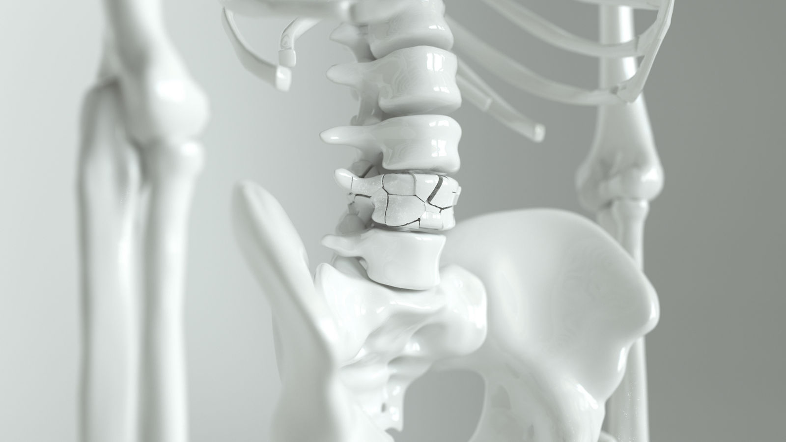 Osteoporosis on the spine - 3d rendering