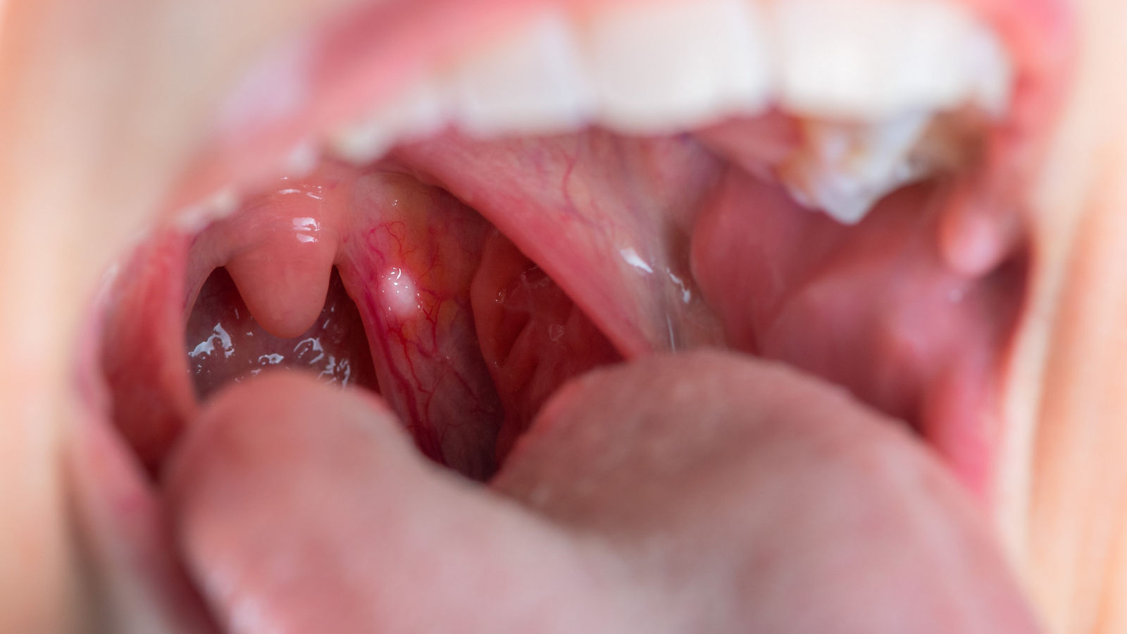 Close up on a canker sores. Inflammation of oral cavity. Very painful aphthae on uvula or soft palate. Really disturbing mouth ulcers. Anatomy of a inflamed buccal cavity. Reddened buccal mucosa.