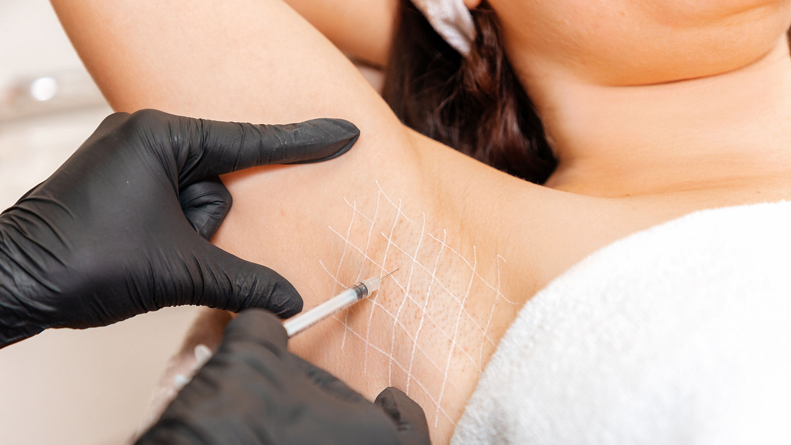 Cosmetologist in black latex gloves makes injection of botulinum toxin on the woman's axillary hollows against hyperhidrosis. Armpit with white drawn grid. Close up