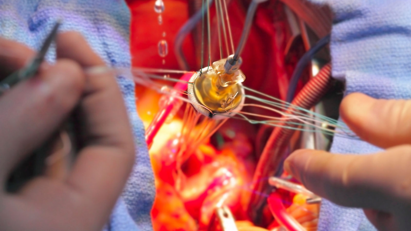 artificial heart valve in the implantation process.