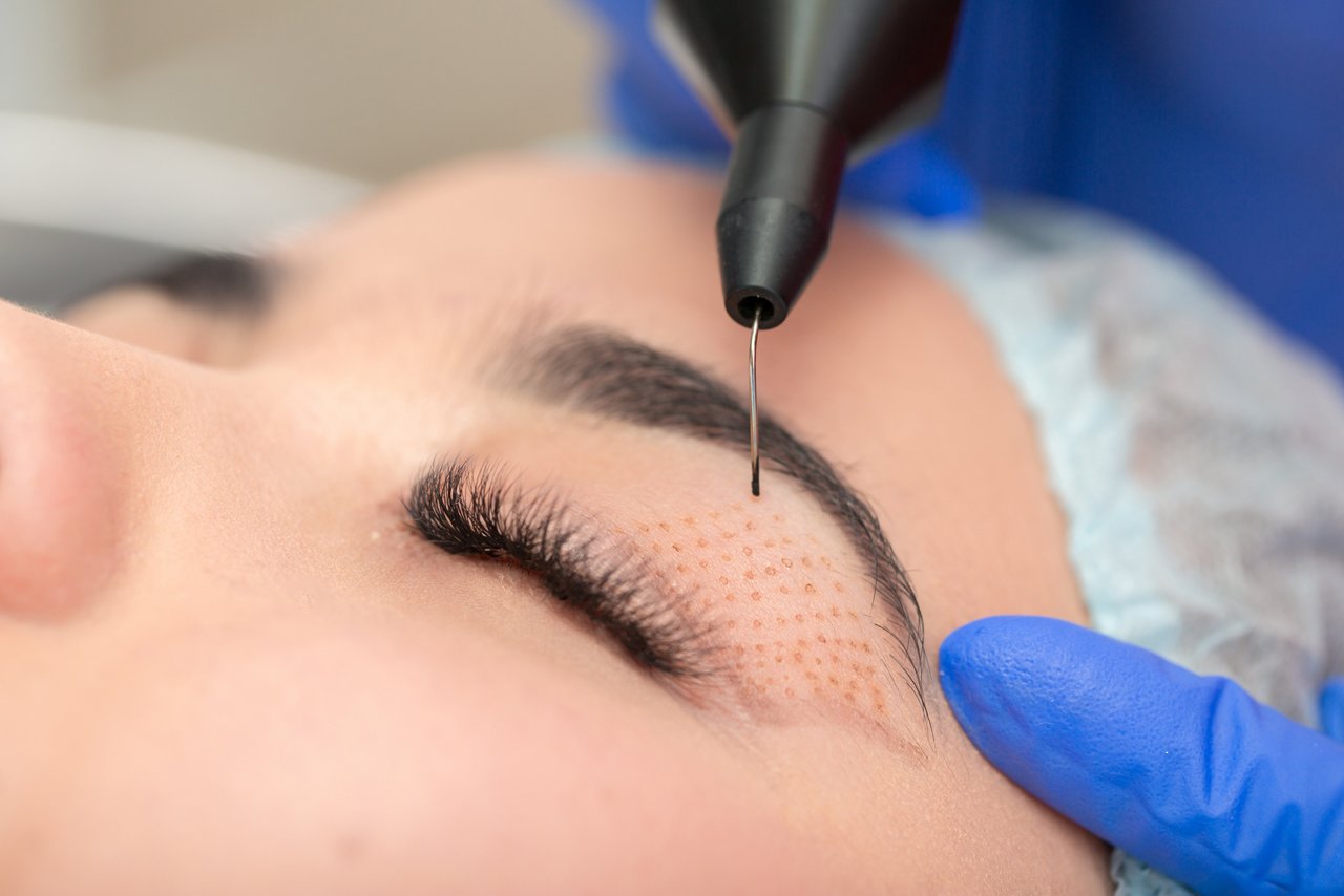 Cosmetic procedure for lifting the skin of the eyelids of Asian eyes. Non-surgical blepharoplasty with plasma IQ apparatus. Facial rejuvenation cosmetology. Beautician makes a cosmetic procedure.