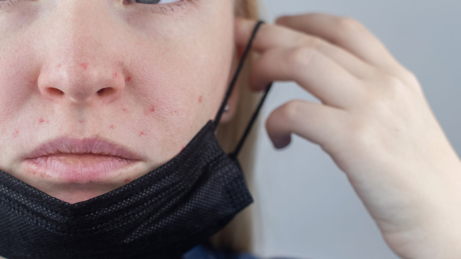 Woman removes the protective mask and shows irritation on face skin. Antiviral measures. Means of protection against covid 19. Long wearing of a mask. Acne on face and chafing. Dry lips and red dots