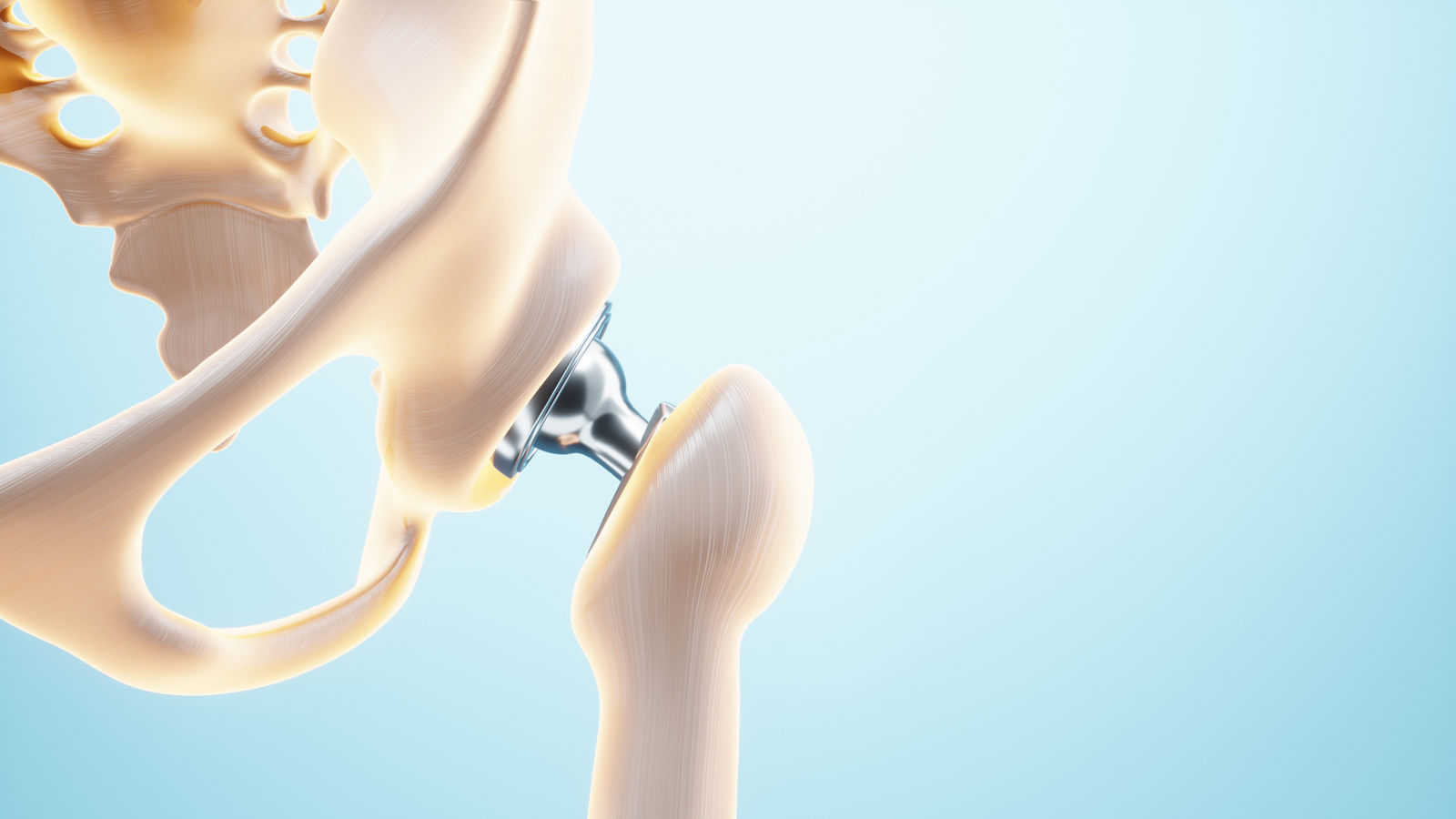 Medical poster image of a hip implant. artificial joint, Arthritis, inflammation, fracture, cartilage. 3D illustration, 3D render.