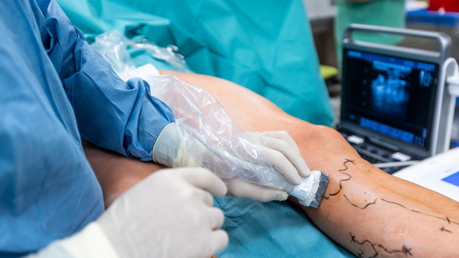 Process of varicose vein surgery in hospital, operating room, vein sealing, venous vascular surgery concept