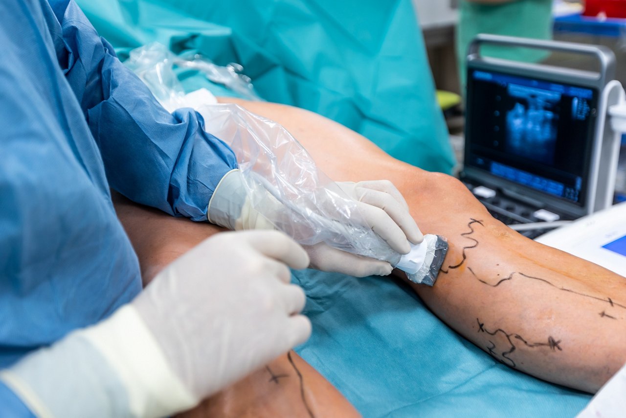 Process of varicose vein surgery in a hospital, operating room, vein sealing, venous vascular surgery concept