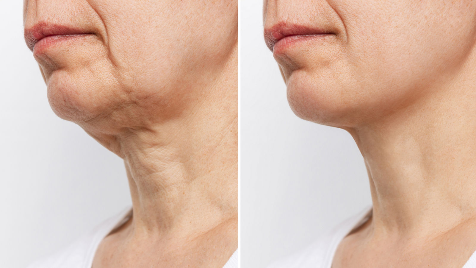 Lower part of the face and neck of elderly woman with signs of skin aging before and after facelift, plastic surgery on white background. Age-related changes, flabby sagging skin, wrinkles, creases