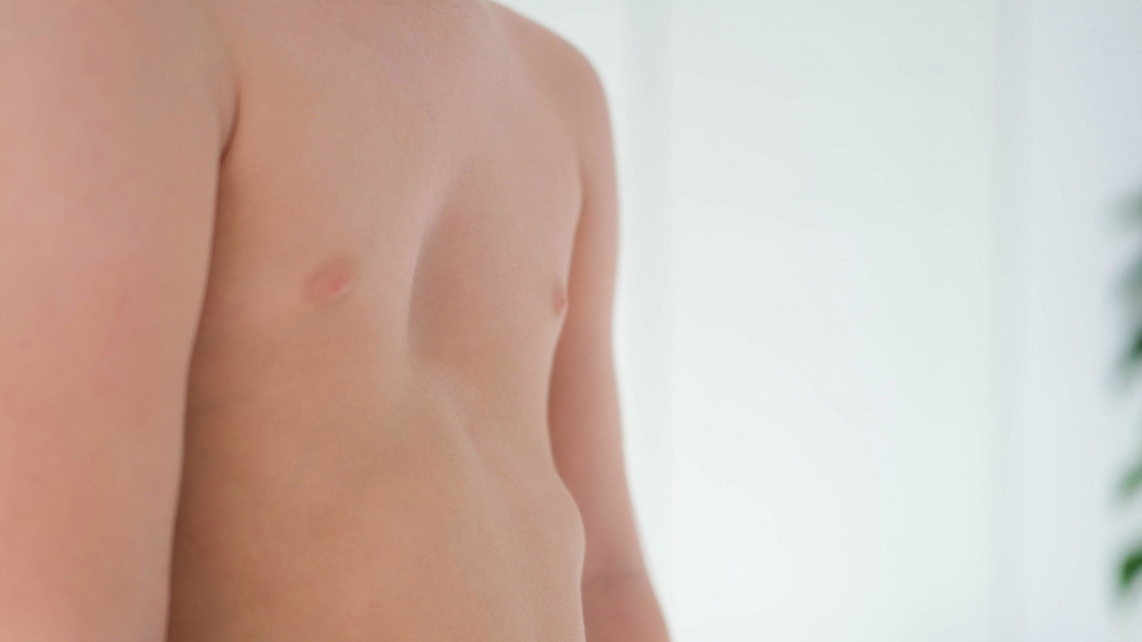 A child with a pectus excavatum. Rickets is a consequence of vitamin D deficiency.