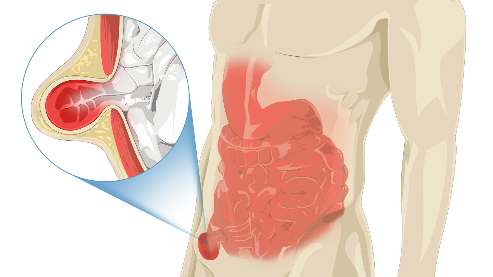 Was ist eine Hernie: Ursachen, Symptome, Behandlung | Helios Gesundheit