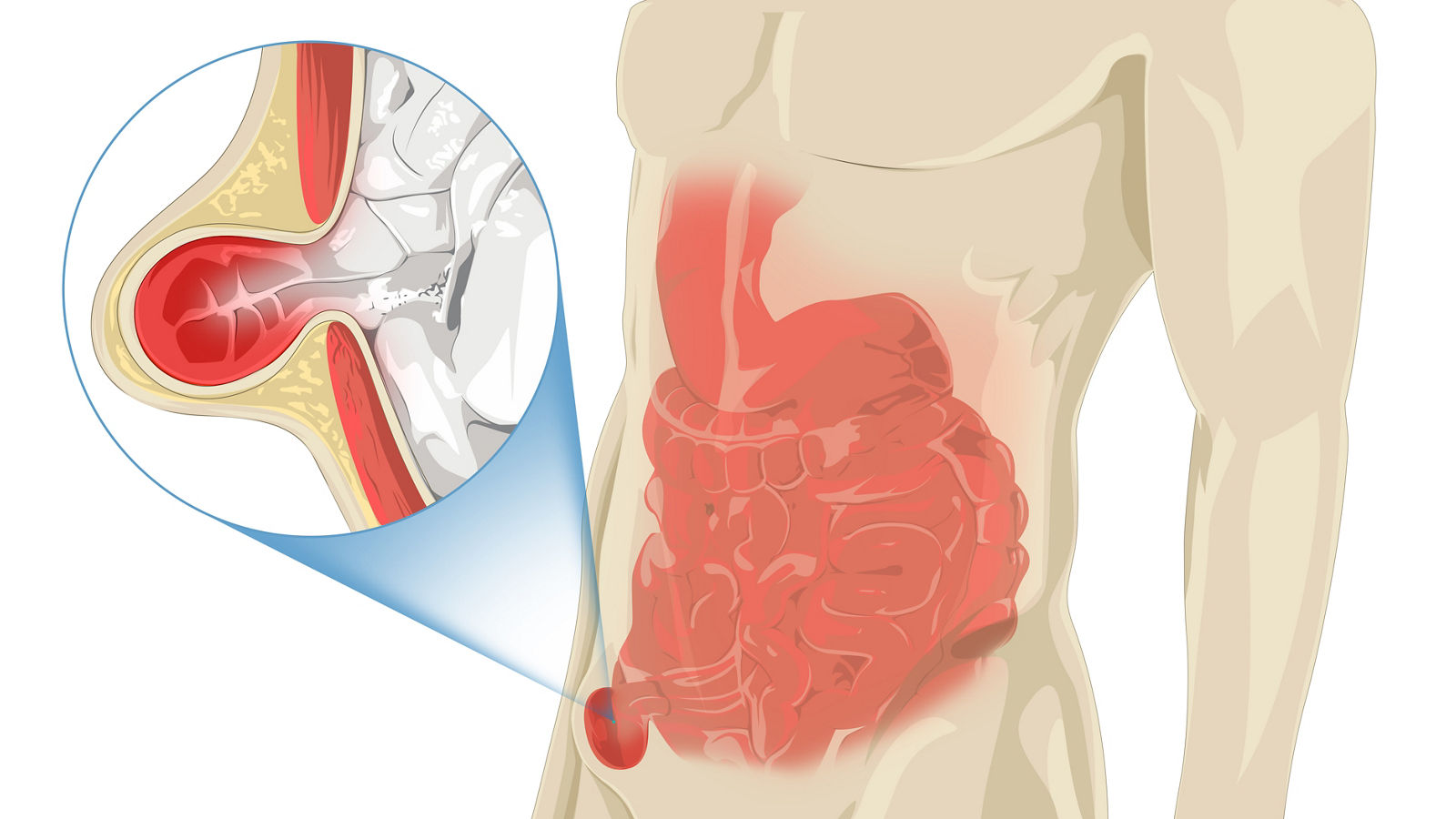 Illustration einer Hernie-Leistenbruch