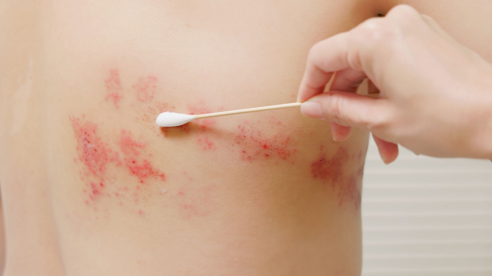 man with shingles disease
