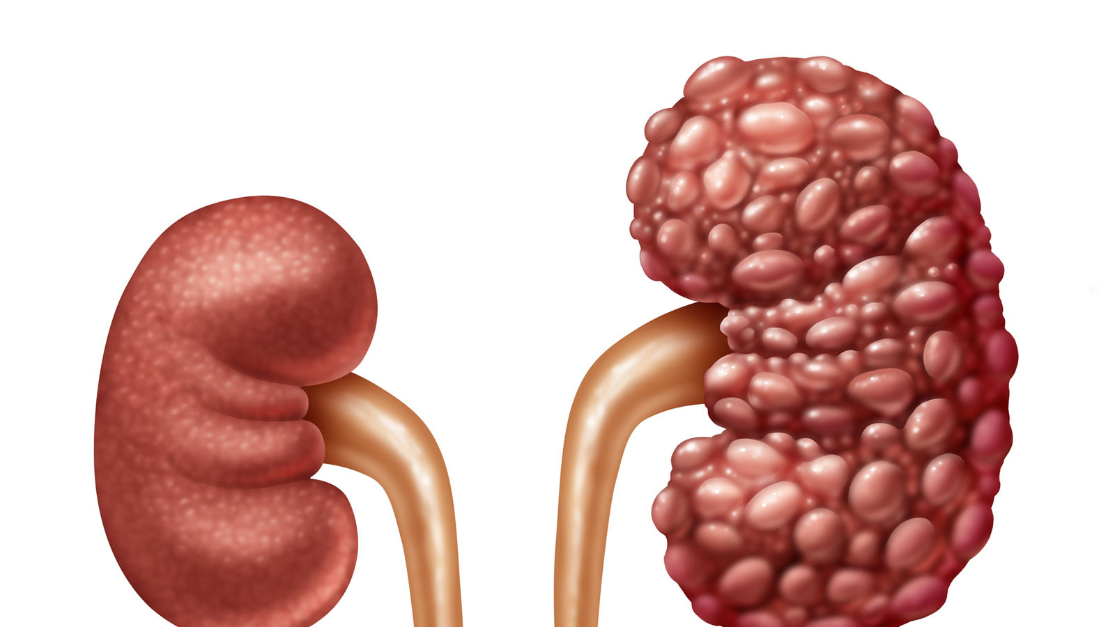 Chronic Kidney Disease