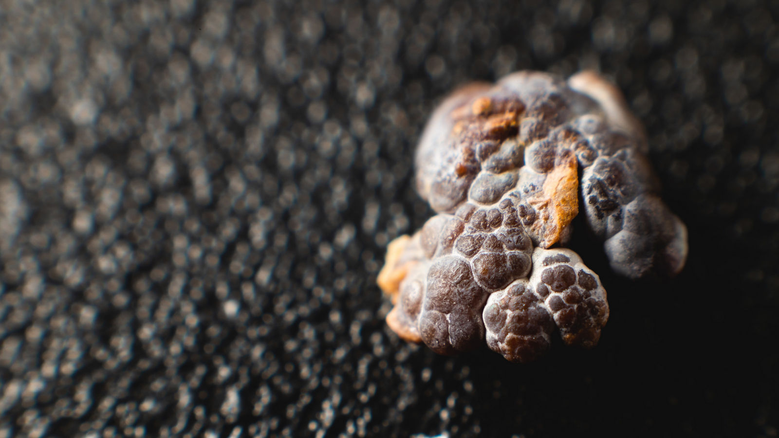 Close-up of a kidney stone. Neoplasm urolithiasis of the kidneys. nephrolithiasis - Closeup shot of a kidney stone renal calculus or nephrolith on a black porous background.
