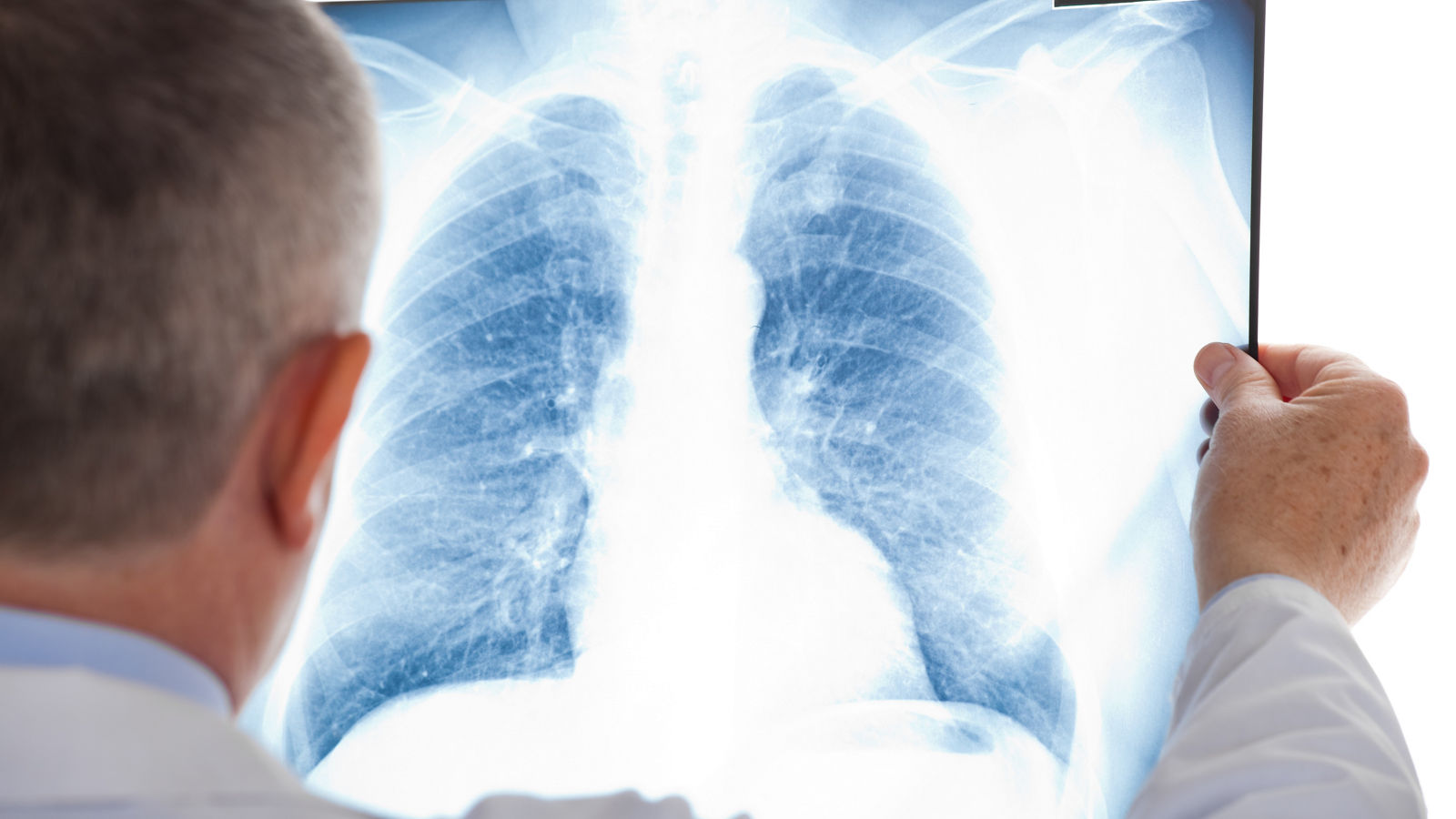 Doctor examining a lung radiography