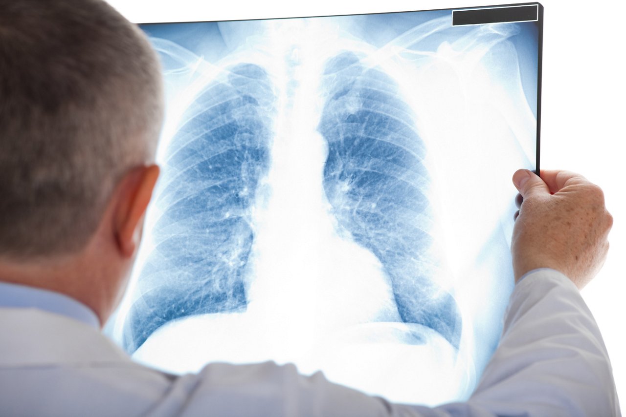 Arzt sieht sich ein Röntgenbild der Lunge an