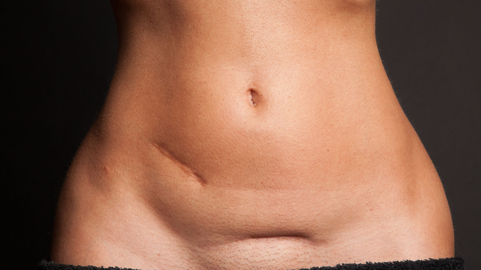 Bauch einer schlanken Frau mit Narben