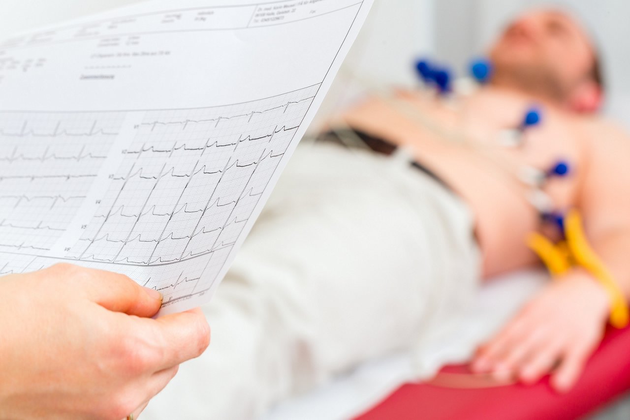 Im EKG lassen sich Herzrhythmusstörungen erkennen.