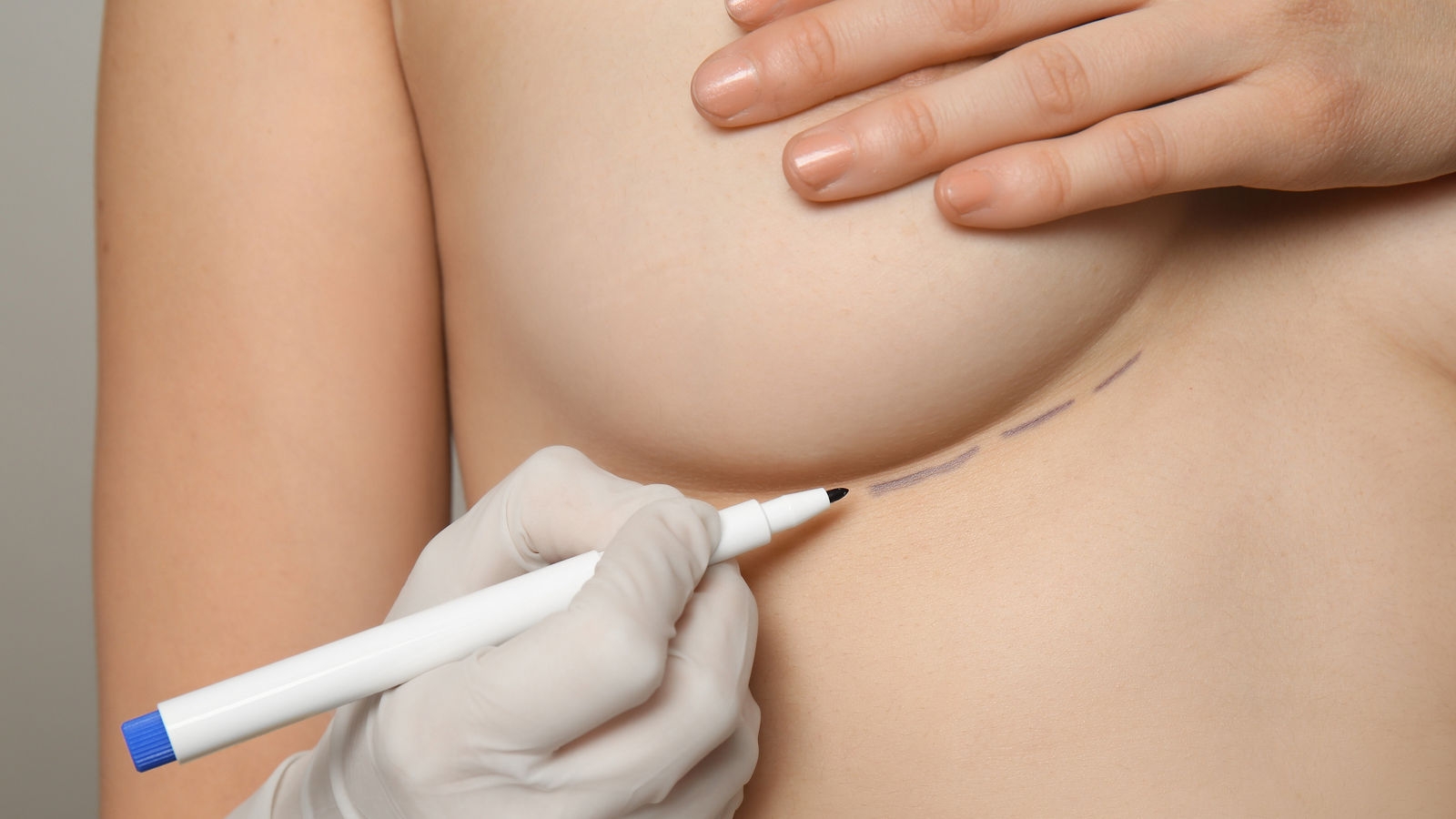 Doctor drawing marks on female breast before cosmetic surgery operation, closeup