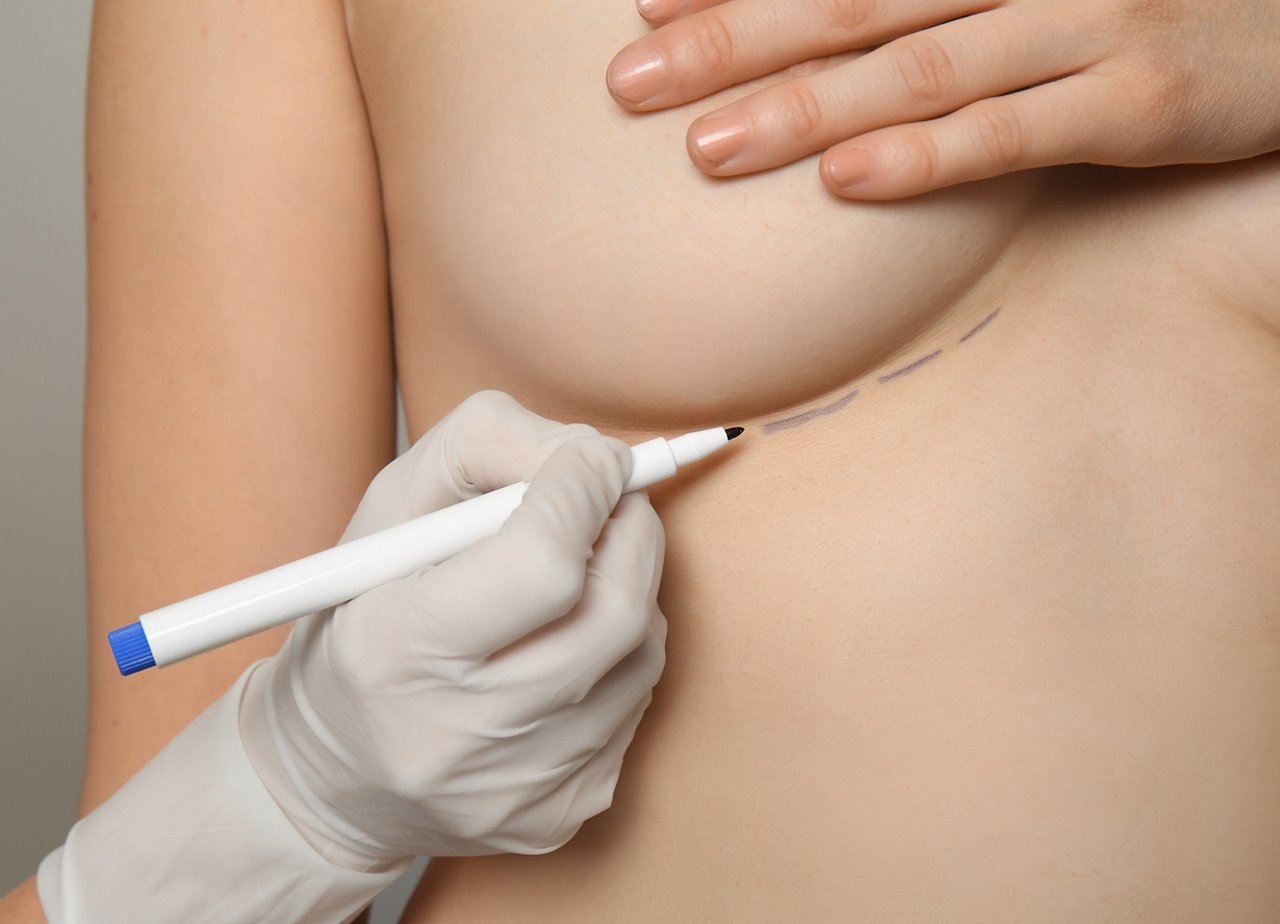 Doctor drawing marks on female breast before cosmetic surgery operation, closeup