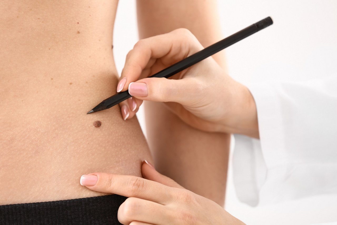 Dermatologist applying marks onto patient's skin before moles removal, closeup