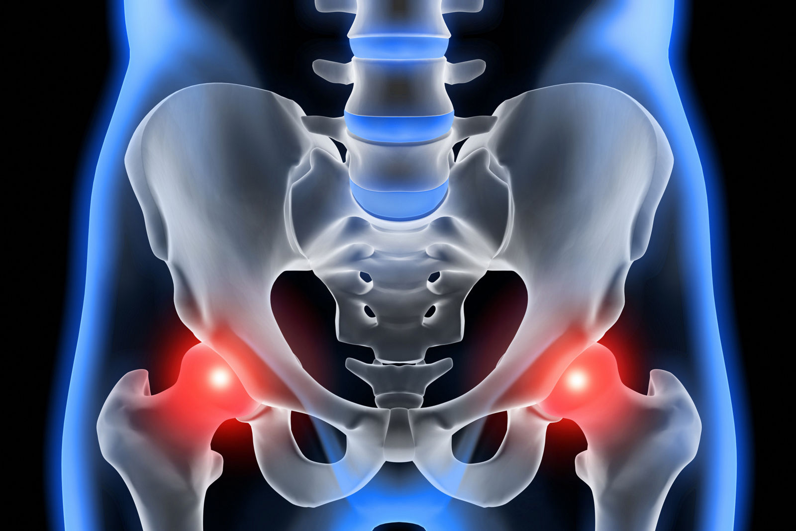 Nicht jeder Hüftschmerz endet im künstlichen Gelenk