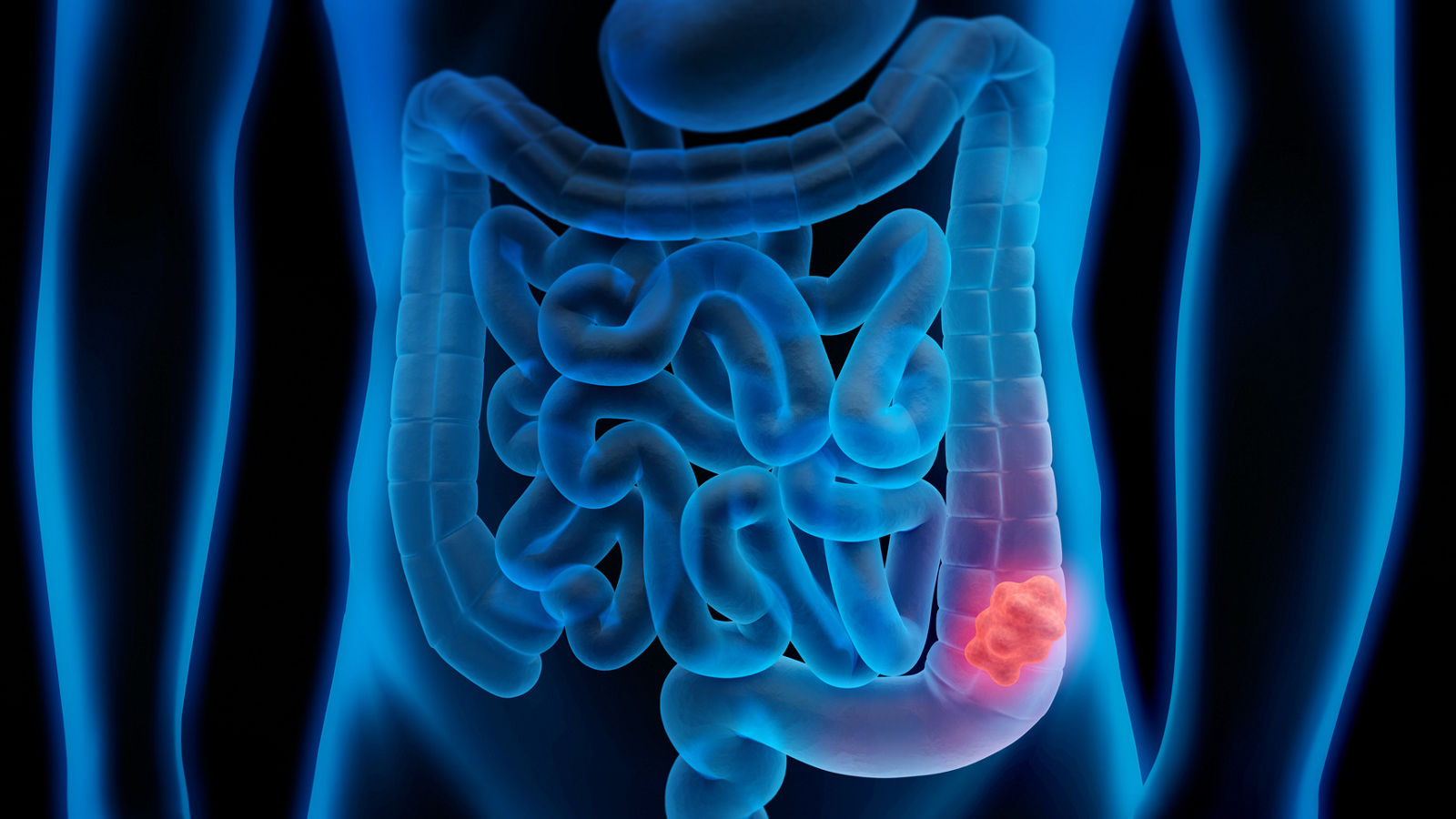 Darmpolyp
