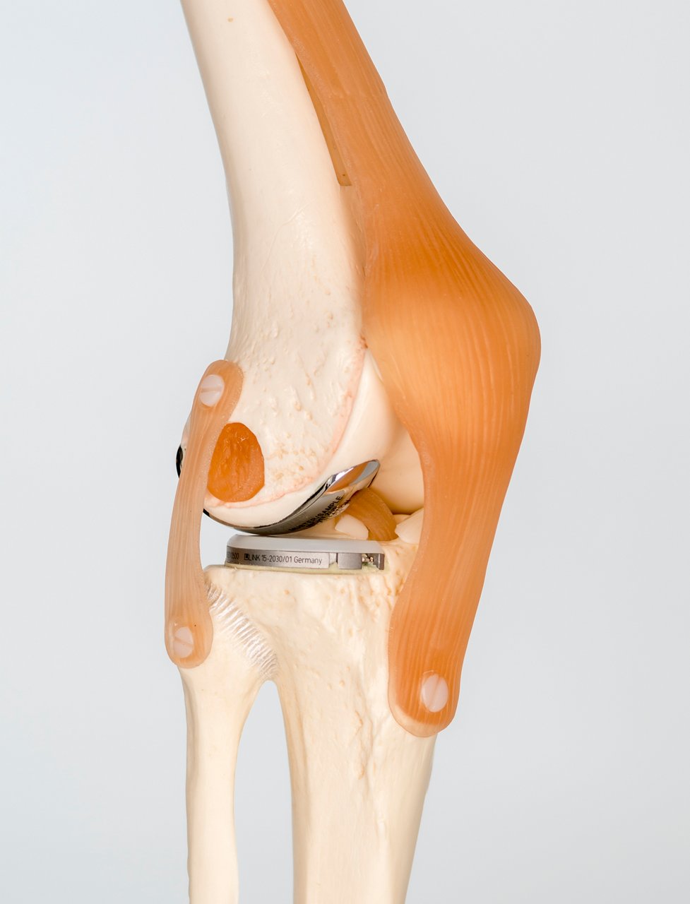 Modelle einer Knieendoprothese ENDO-Klinik Hamburg-
