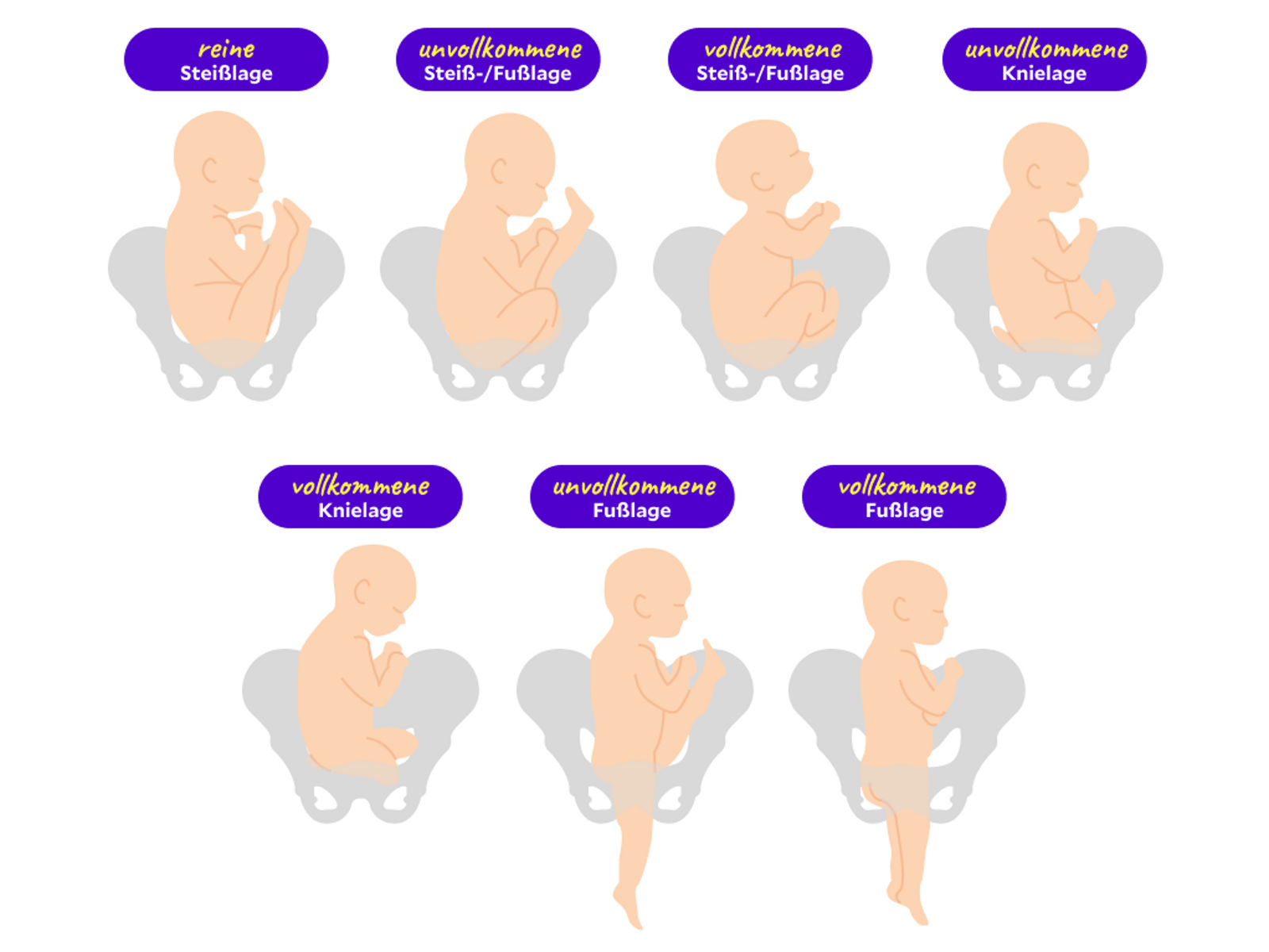 7 verschiedene Positionen der Beckenendlage als Illustration