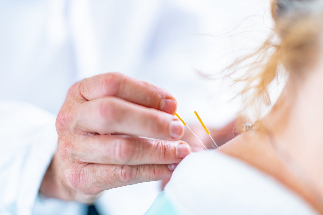 Hände eine Arztes beim Setzen von Akupunkturnadeln am Rücken einer Patientin