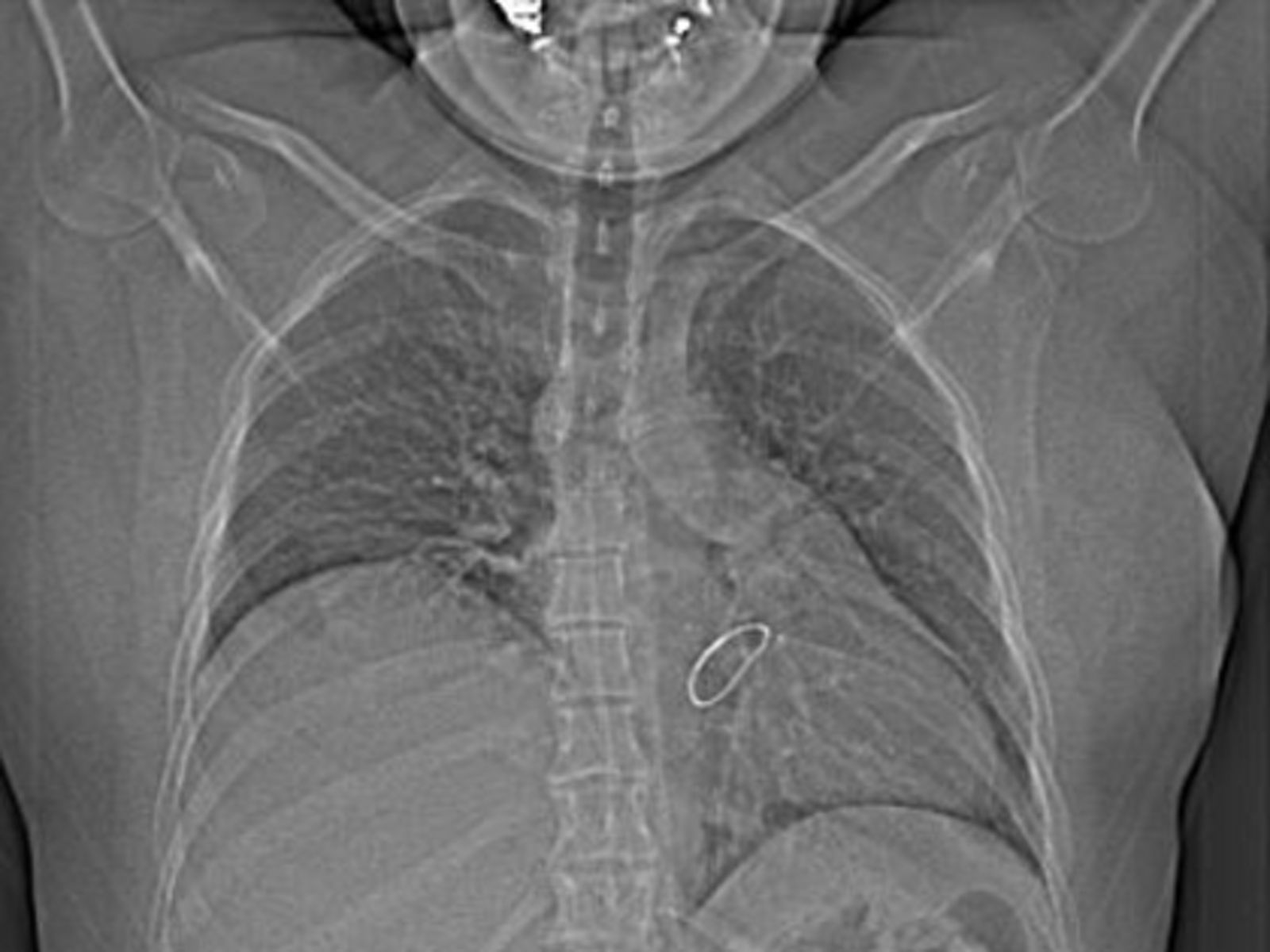 Präoperativ  Zwerchfellhochstand 