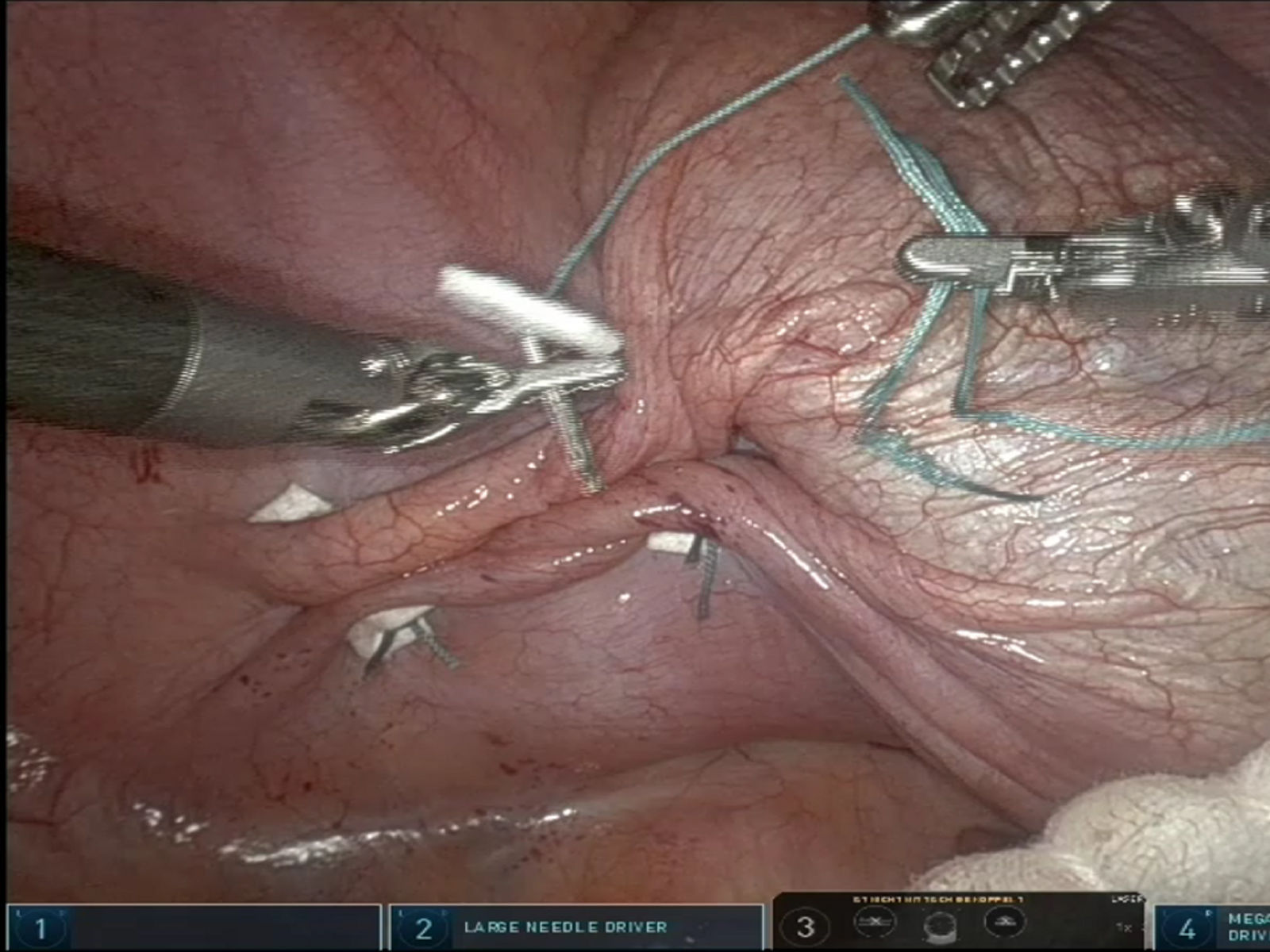 Intraoperativer Blick