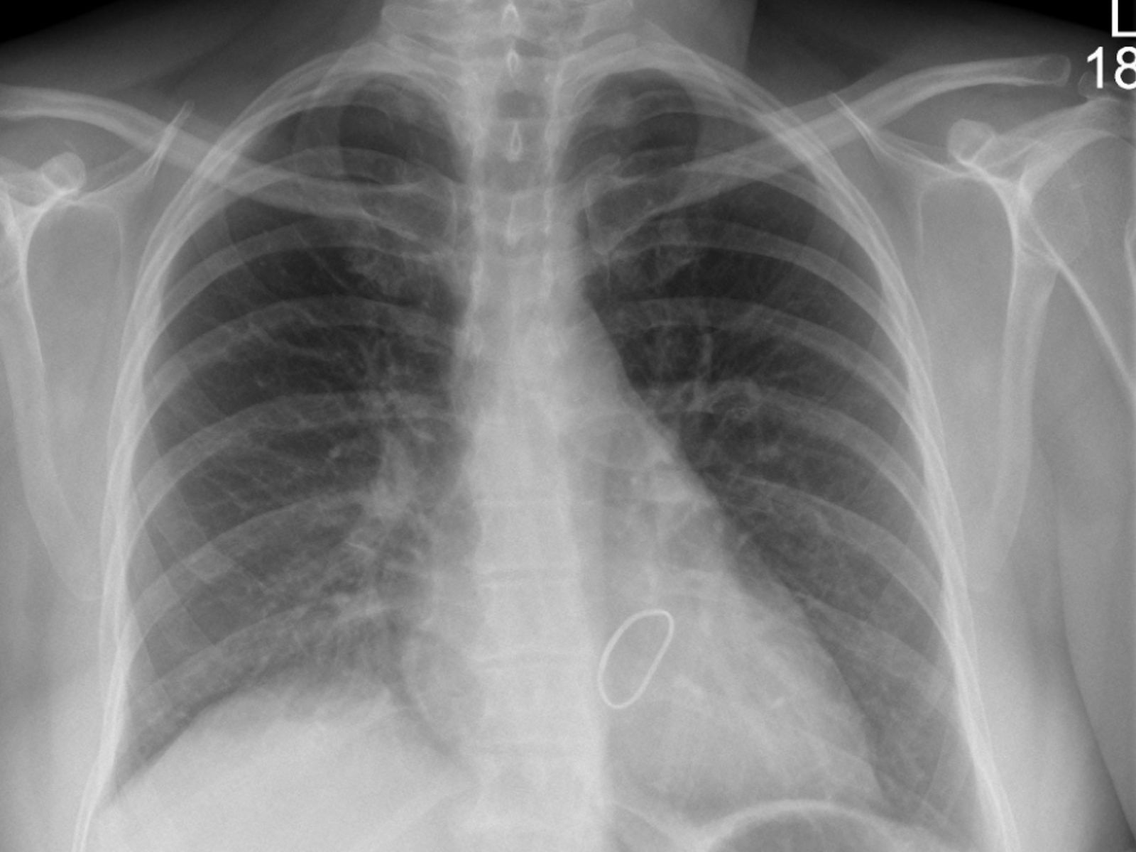 Postoperativ Zwerchfellhochstand