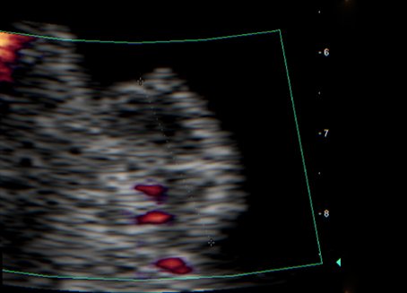 Ultraschallaufnahme Harnblasentumor