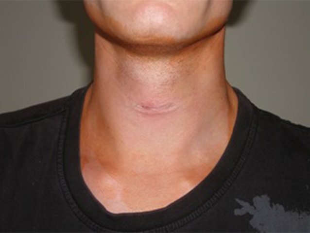 Abb.: Befundbeispiel am ersten Tag nach Hemithyreoidektomie in Minet-Technik mit geklebtem Hautverschluss