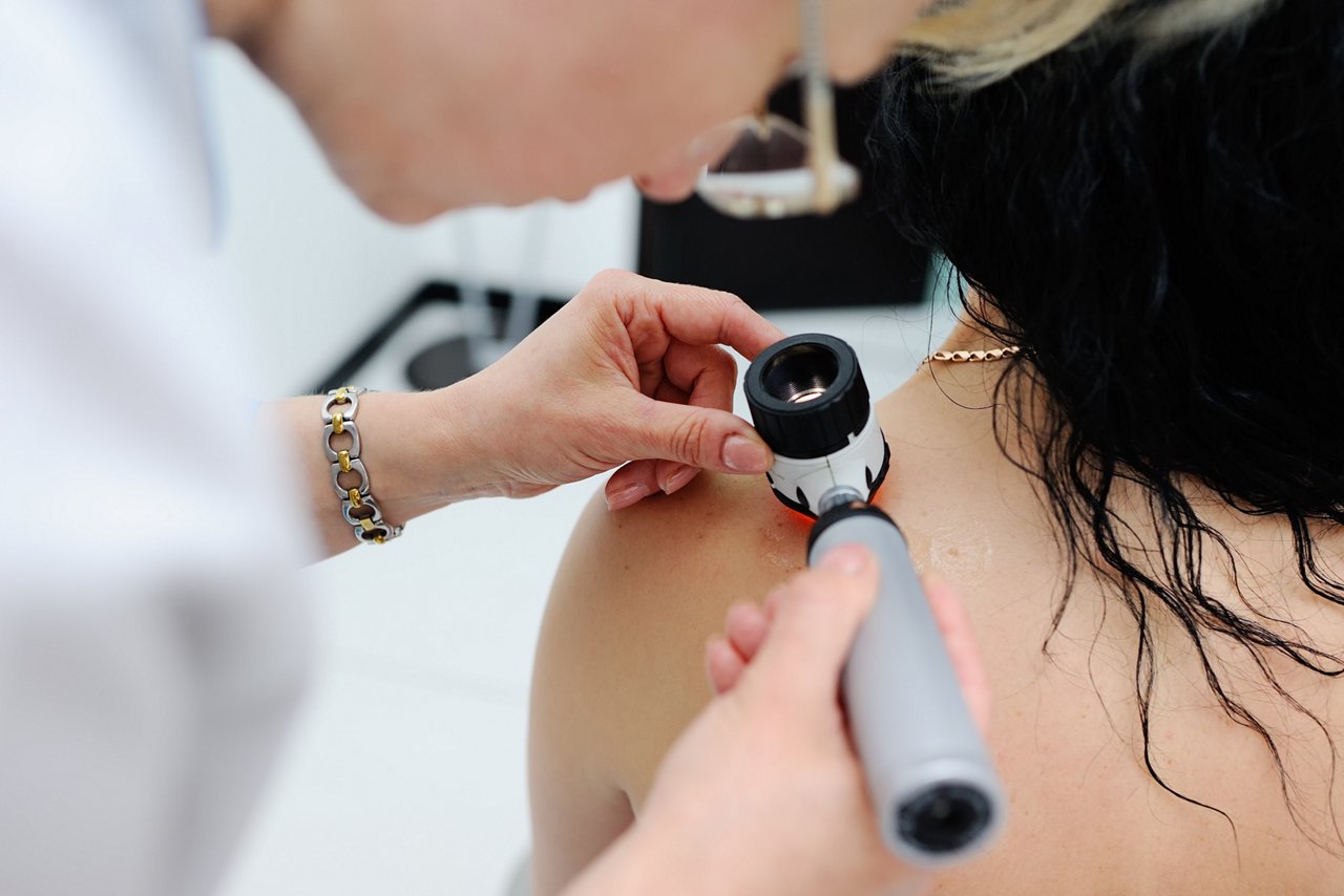 Doctor examining birthmarks and moles patient. examination of birthmarks and moles.the doctor examines the patient's mole