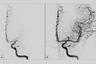 Bilder einer Angiografie