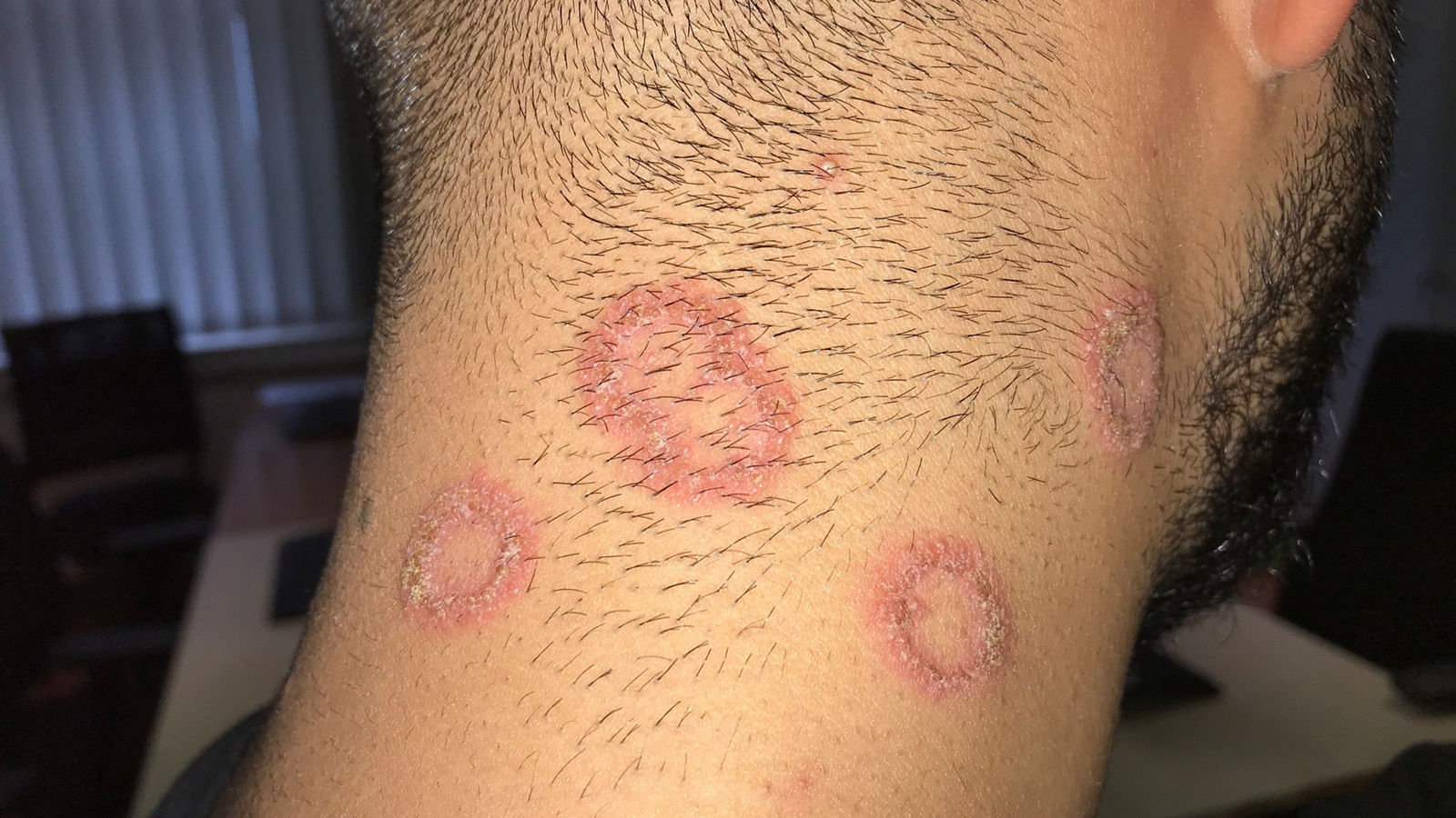 Klinisches Bild einer Mykose am Kopf