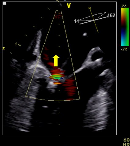 Echokardiografie nach einer kathetergestützten Rekonstruktion der Mitralklappe
