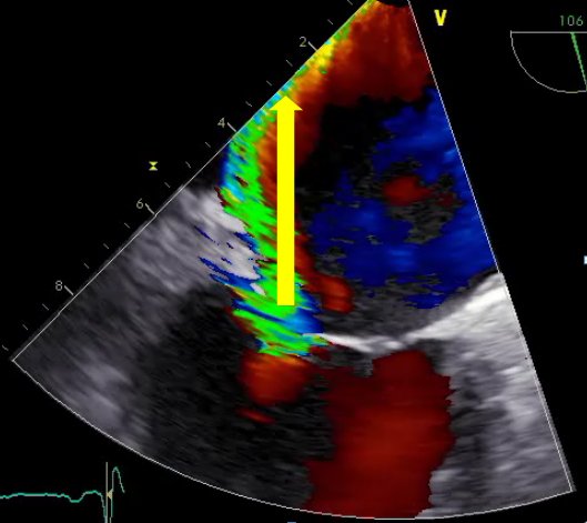 Echokardiografie vor einer kathetergestützten Rekonstruktion der Mitralklappe