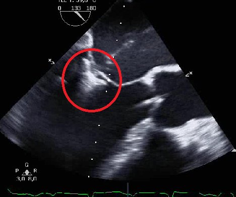 Echokardiografie während einer kathetergestützten Rekonstruktion der Mitralklappe