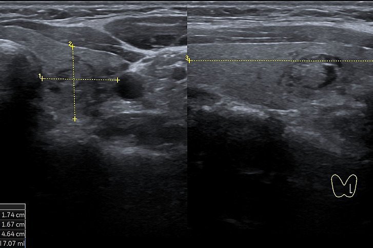 Sonografie Schilddruese