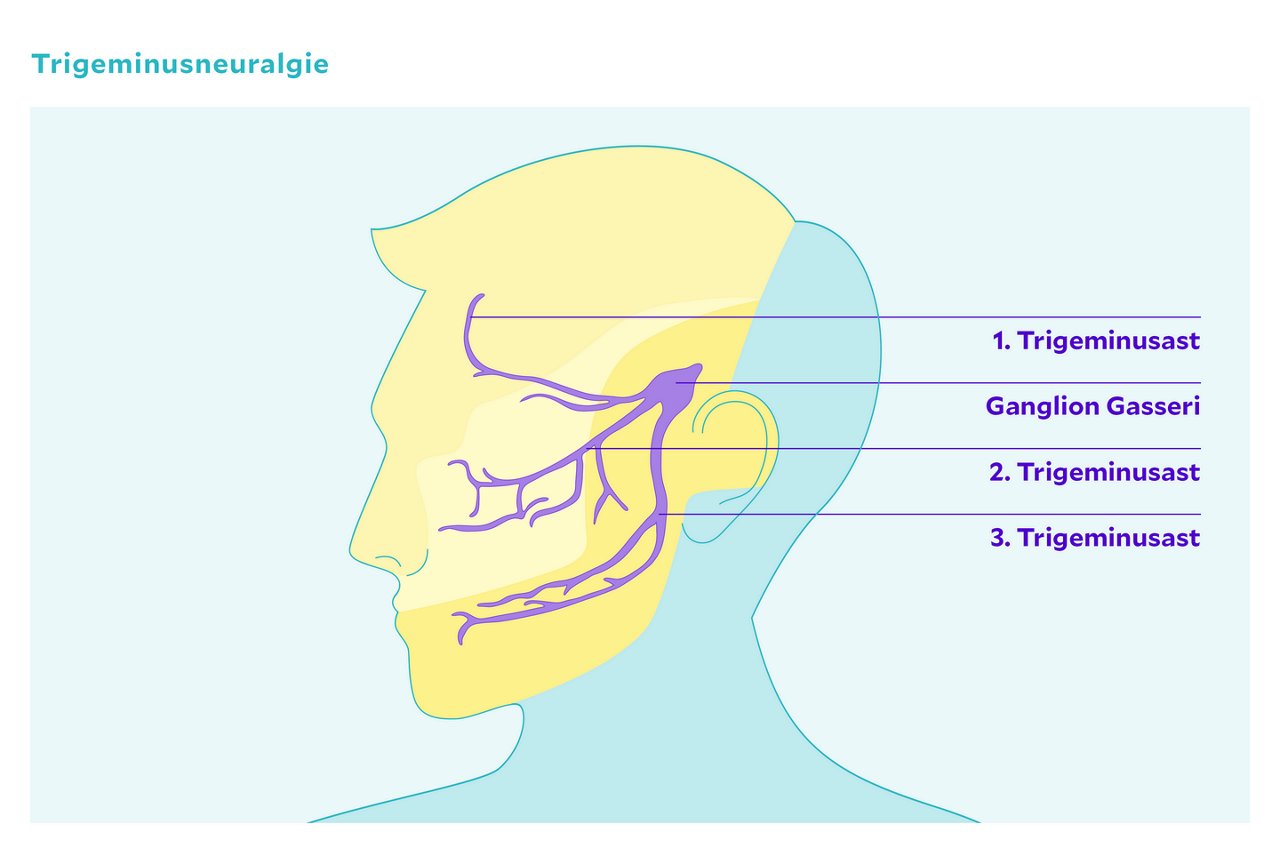 Der Trigeminusnerv verzweigt in drei Hauptäste