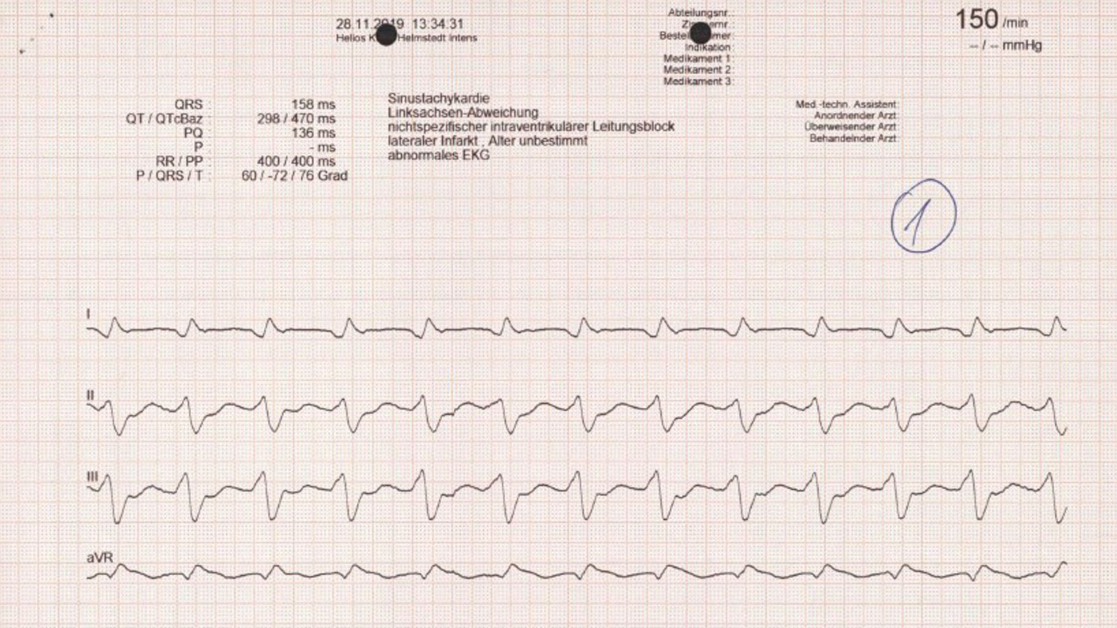 Ablation von Kammertachykardie mit Herzpumpe