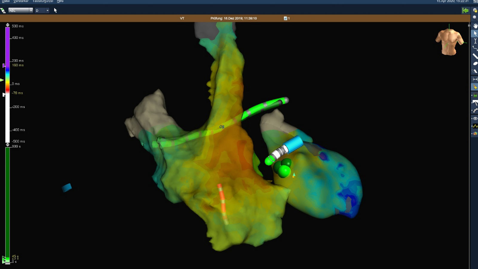 Ablation von Kammertachykardie mit Herzpumpe
