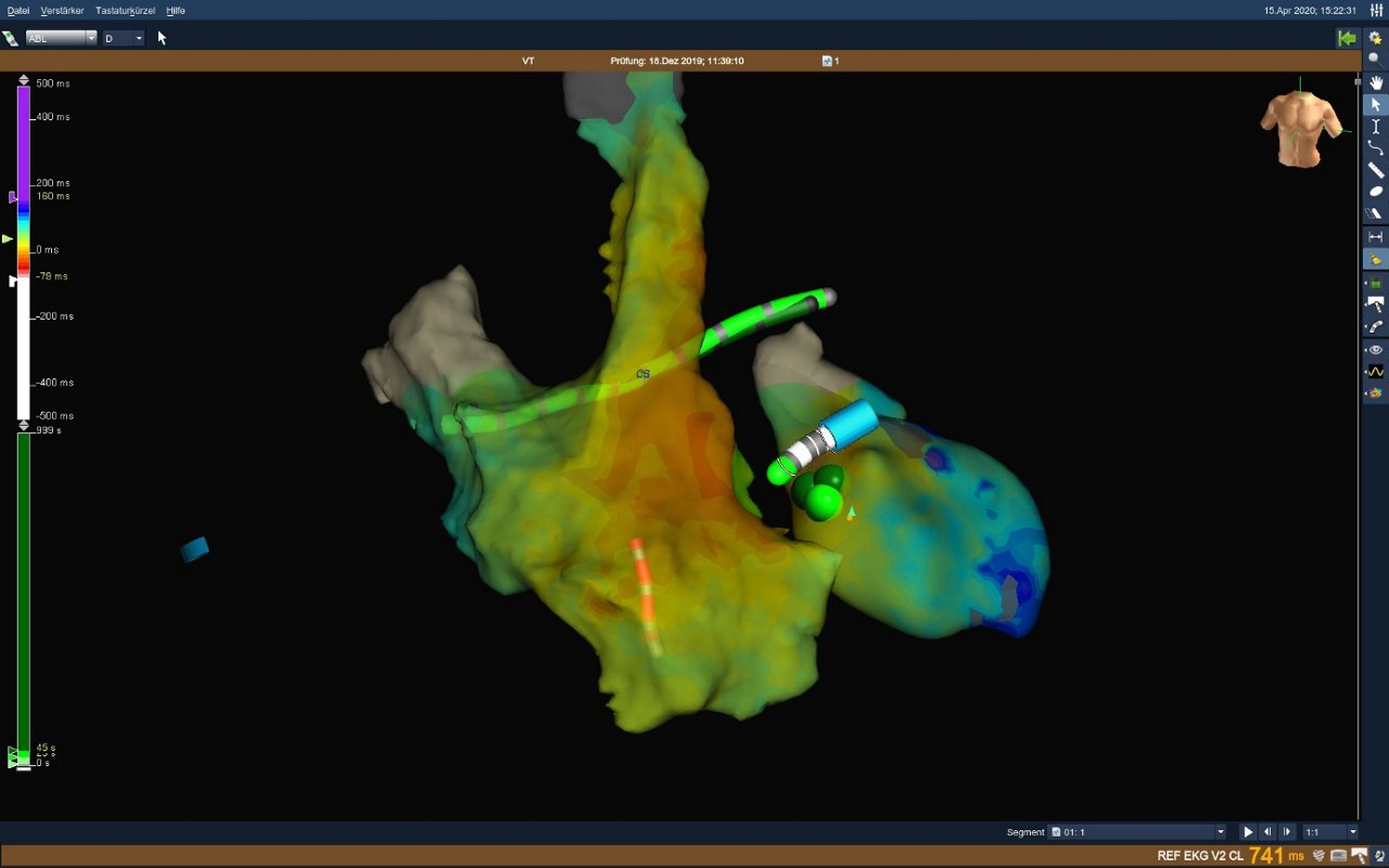 Abbildung 3: 3D-Mapping mit NAVX Ensite Precision mit Identifizierung der frühesten Stelle am Septum des linken Ventrikels mit zentrifugaler Ausbreitung. An dieser Stelle erfolgte die gezielte Ablation (grüne Punkte). 
