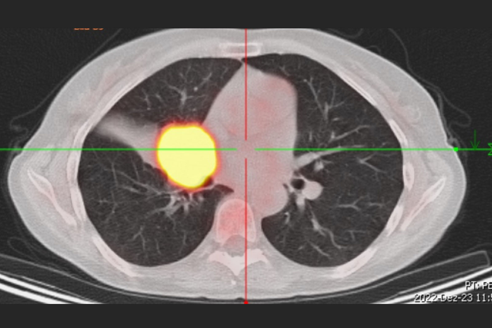 Pneumonektomie Bild 1