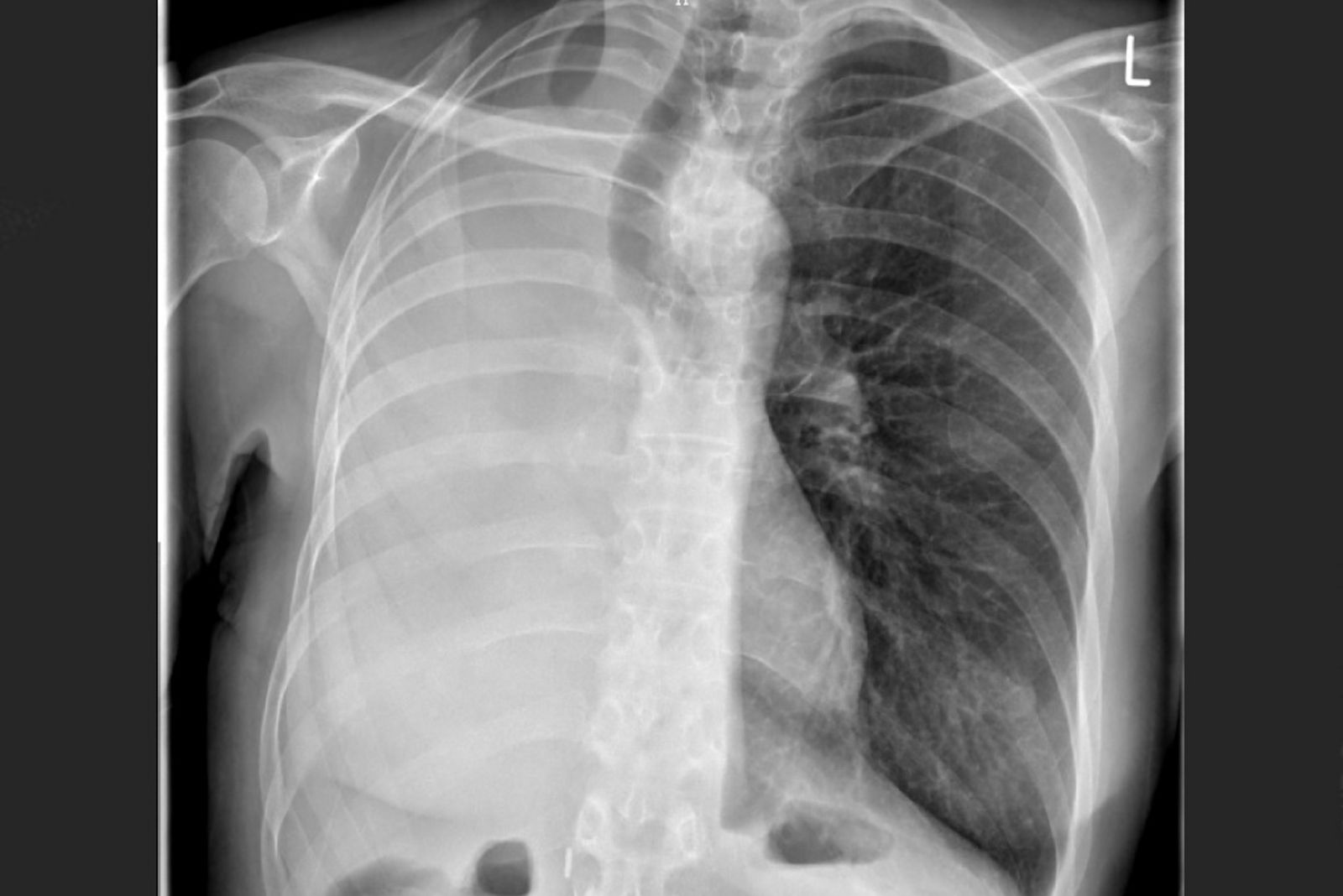 Pneumonektomie Bild 2