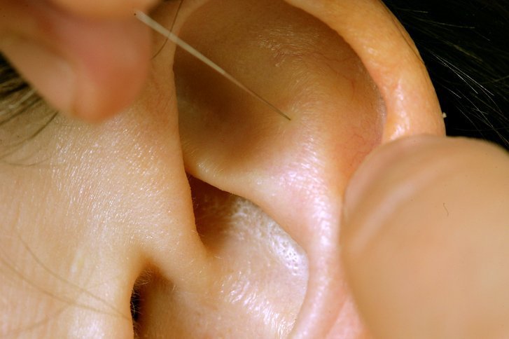 Akupunktur am Ohr als Schmerztherapie für eine schmerzarme Geburt